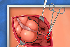 艾梅医生阑尾炎手术