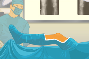 膝关节置换手术