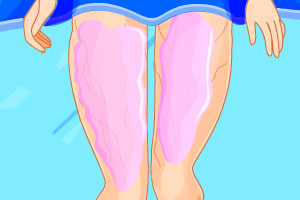 艾拉的腿部整形